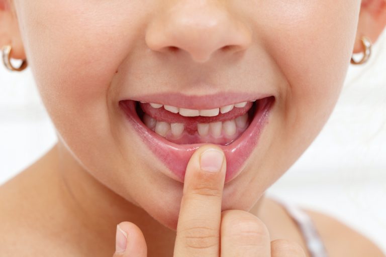 Your Child Knocked Out a Tooth? What To Do