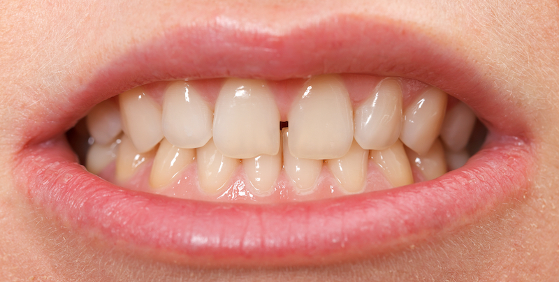 A close up picture of a set of teeth prior to getting BioClear treatment at Dentistry At the Grove