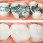 Dental Fillings - Types & Procedure