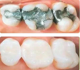 Fillings - Back 2 Basics Dentistry