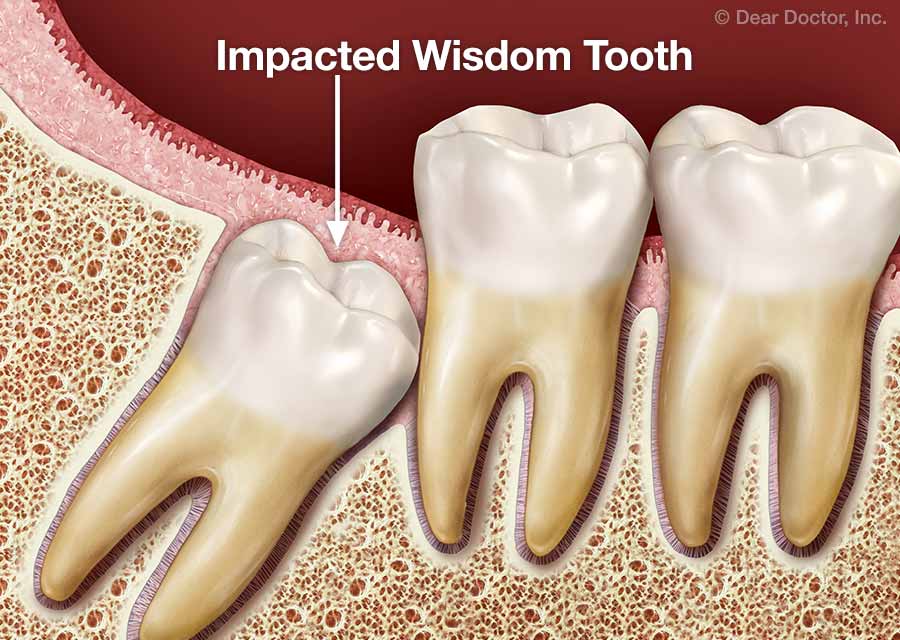 what advice would a wisdom tooth have essay example